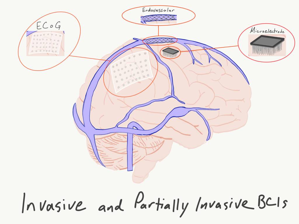 Exemples d'EEG invasifs et partiellement invasifs